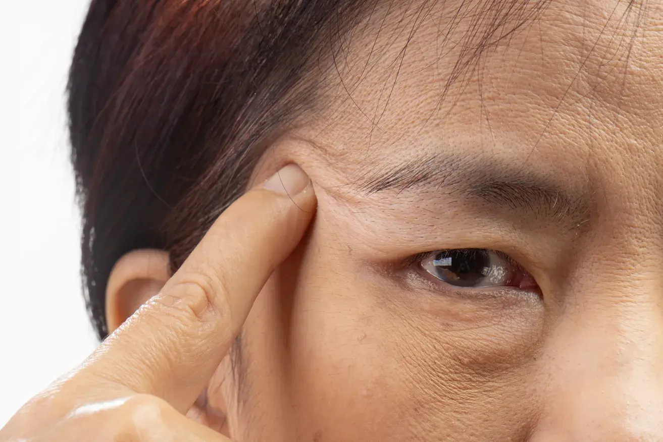 Woman with drooping upper eyelids