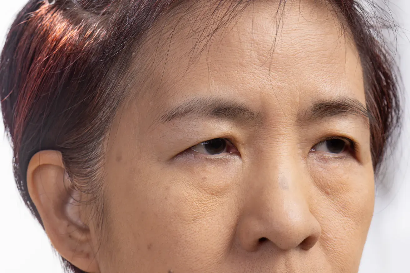 Close up of elderly woman with ptosis