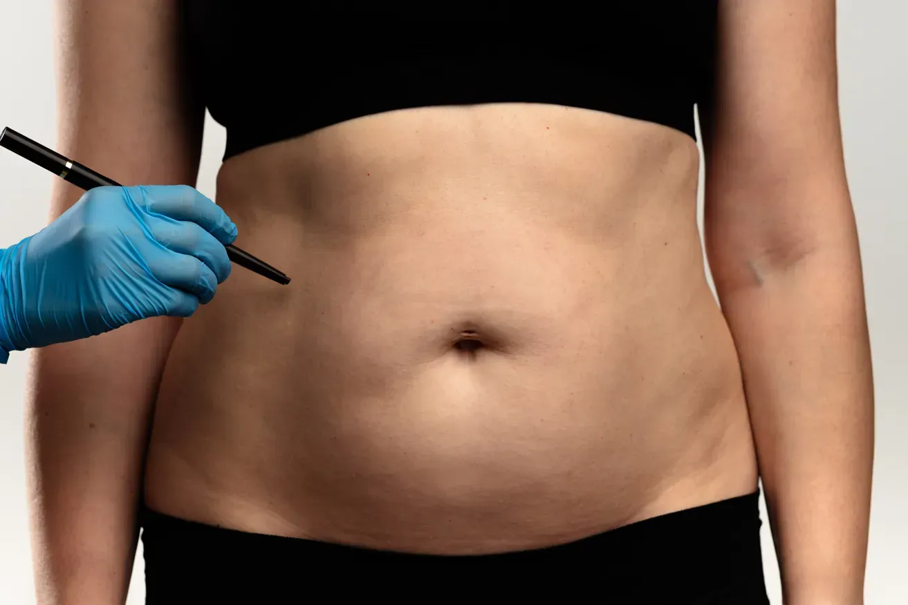 Plastic surgeon preparing to draw preoperative markings on a woman's abdomen before liposuction