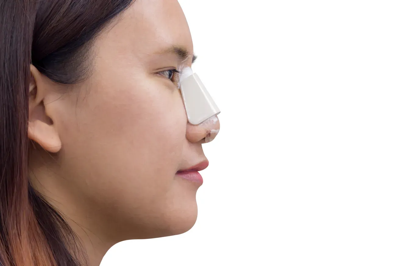 Side profile view of a woman wearing a nasal splint after rhinoplasty
