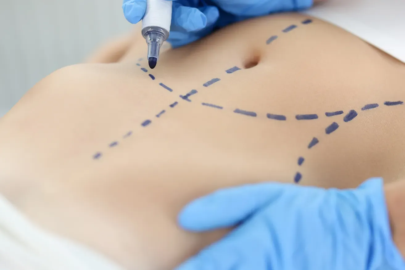 Plastic surgeon marking patient’s body for liposuction