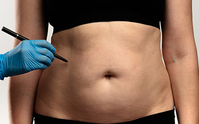 Plastic surgeon preparing to draw preoperative markings on a woman's abdomen before liposuction.