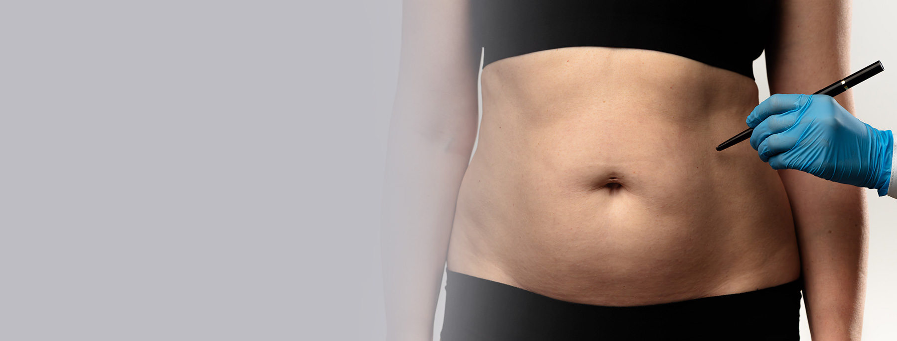 Plastic surgeon preparing to draw preoperative markings on a woman's abdomen before liposuction.