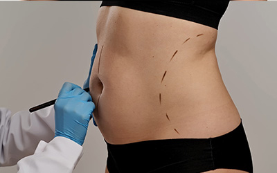 Plastic surgeon drawing preoperative markings on a woman's abdomen.