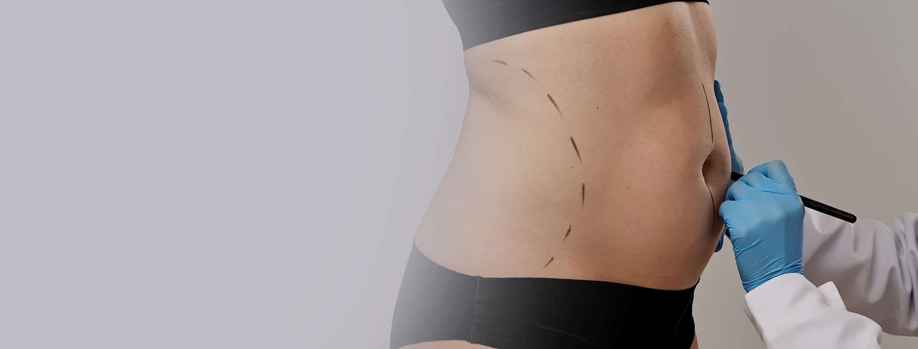 Plastic surgeon drawing preoperative markings on a woman's abdomen.