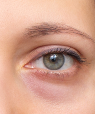 How Eyebag Surgery Is Performed - Blog Thumbnail