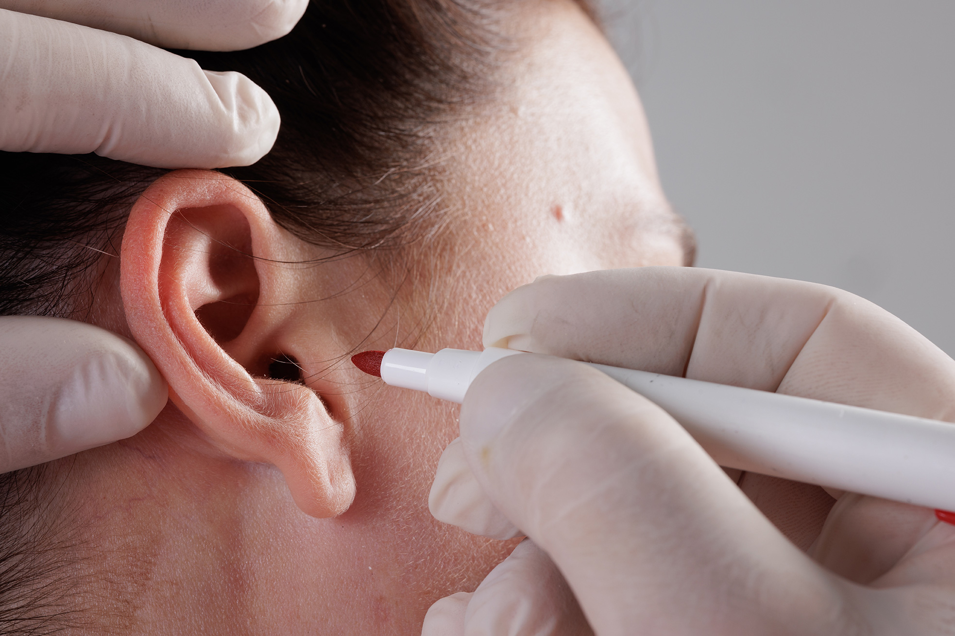 Plastic surgeon preparing patient for ear recovery surgery
