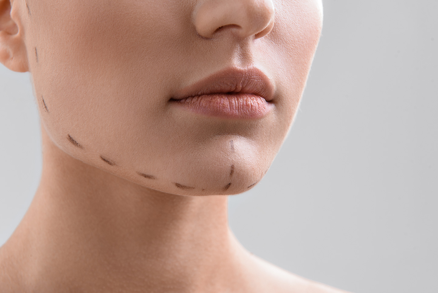 Woman with preoperative surgical markings on her face before a cosmetic procedure.