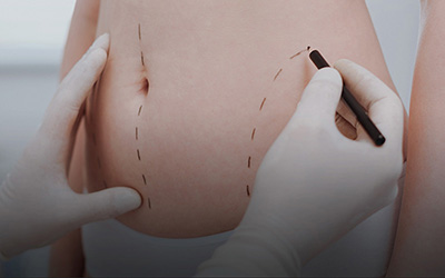 Vaser Liposuction Surgery