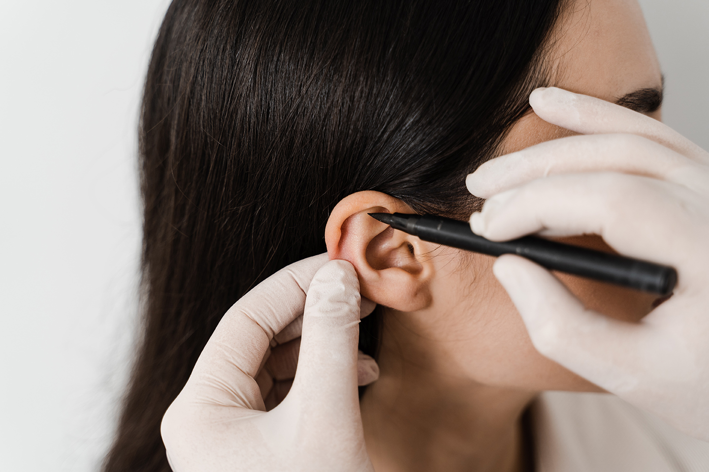 Close-up of surgeon marking ear before otoplasty for ear reshaping.
